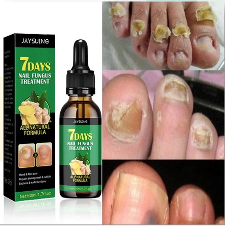 Tratamiento Antihongos con Aceite de Jengibre 30ml