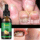 Tratamiento Antihongos con Aceite de Jengibre 30ml