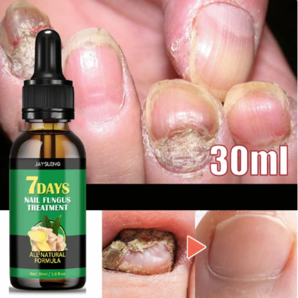 Tratamiento Antihongos con Aceite de Jengibre 30ml